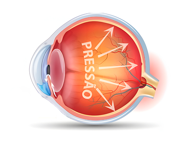 Glaucoma e pressão ocular – o que você precisa saber 1 Glaucoma e Pressão Ocular: Ilustração médica mostrando a pressão intraocular elevada afetando o nervo óptico no glaucoma, destacando a importância do diagnóstico precoce para prevenção da cegueira.