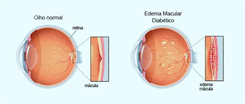 Edema macular diabético: sintomas, diagnóstico e tratamento 1 Zoom no olho de paciente com diagnóstico de edema macular diabético.